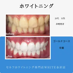 【冬のお試しキャンペーン】まずはお試し♪ホワイトニング12×2回　¥4,980→¥1,980