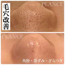 30分クイックフェイシャル！毛穴改善アンケートモニター募集👃