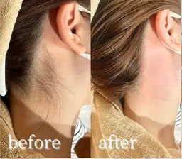 🇯🇵✨ 新規様限定メニュー：うなじ美人脱毛ケア ✨🇧🇷 アップスタイルが際立つ！✨ 憧れの「うなじ美人」へ！
