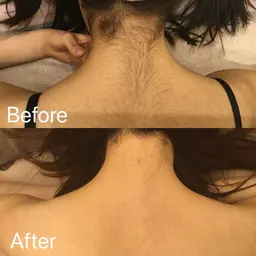 【襟足＋背中中上部脱毛】コラーゲン脱毛30分体験(シェービング付⭐︎)