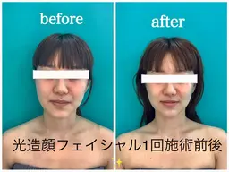 12月平日限定🈹【人気No.2🥈】光造顔フェイシャル60分小顔、たるみ解消👍¥7,200→¥4,300