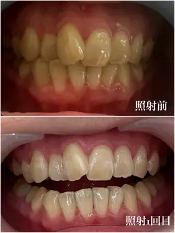 男性限定！個室でセルフホワイトニング【15分×3回】