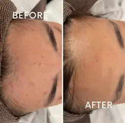 【京都市最安値】美肌顔脱毛✨