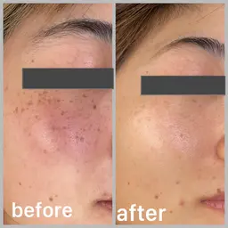 光フェイシャル回数券(3回分)   当日はノーメイクでお越し下さい