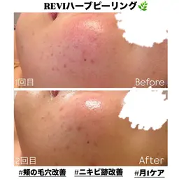 当店人気No.1メニュー✨️【 毛穴・ニキビ集中ケア 】 REVIハーブピーリング🌿
