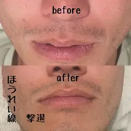 ミニモ限定メニュー✨美容鍼🔥ほうれい線に特化🔥針＋矯正マッサージ💆