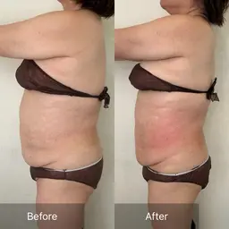 初回最強痩身レモン🍋10cc