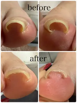 【オフあり】巻爪緩和コース✨️2本(親指)¥7700-/1本¥3850-/お時間は両足分✨️