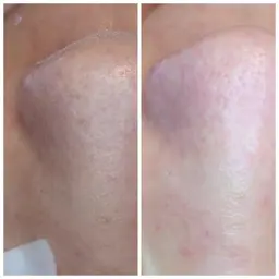 【モニター様】毛穴汚れ根こそぎ洗浄✨6800円→4000円！デコルテリンパ+美白パック付き☆透明感ある艶肌のへ