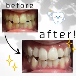 【歯の黄ばみに🦷】まずはお試し👍“8分×3回”で透明感ある自然な歯に!人目を気にせず自分磨き💖ホワイトニング🦷