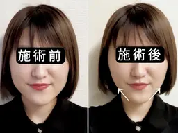 【むくみ・もたつき改善】即効小顔美容鍼