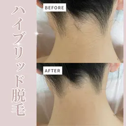 【最新のハイブリッド脱毛🔥】全身脱毛☺️VIO込み💗