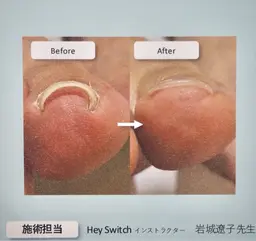 【ｆｏｏｔ】Hey Switchジェル巻き爪ケア