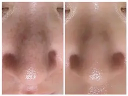 【人気Ｎｏ．1毛穴大洗浄ケア】黒ずみ除去＋小顔造形リンパエステ60分¥3000