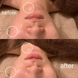 【ニキビにお悩みの方必見】REVI🌹陶肌トリートメント🌿ハーブピーリングモニター様募集☺️一回で効果大です💕