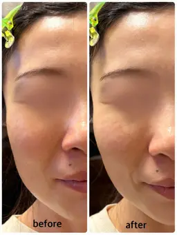 超音波エステ《エステモデル》