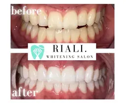 最高級プラチナセルフホワイトニング2来店分◀◁効果抜群