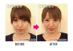 小顔モニター！【ハイパー脂肪撃退小顔美骨】５回¥91.746→¥54000