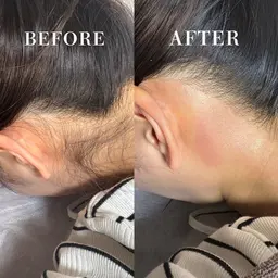 うなじワックス+うなじ光脱毛(ワックス+光脱毛)