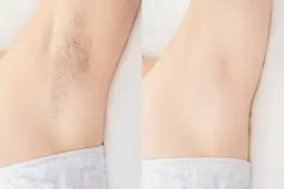 ワキつるつる脱毛💎脱毛デビューの方にオススメ✨