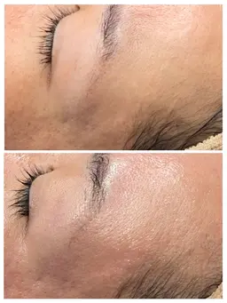 お試しフェイシャルwax   おでこ〜目まわり