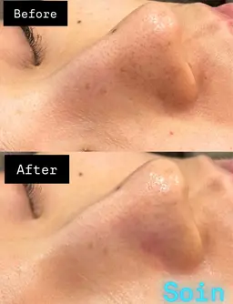 ハイドラ毛穴洗浄/選べるモデリングパック付き¥8,000→¥7,000