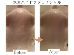 【リピート】水素ハイドラフェイシャル✨