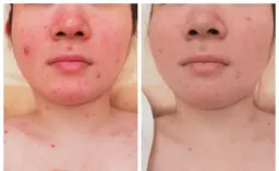 【初回お試し】なめらか肌に変身！ニキビ肌ケア フェイシャル