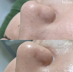 【💎ハイドロスキン💎】毛穴洗浄で全顔つるつる☺️💕小鼻の黒ずみに1回でわかる効果👀ご新規さま¥5,500