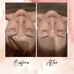 頭蓋骨小顔矯正モニター　1​〜​6回まで　60分