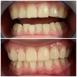 ホワイトニング🦷✨15分1回