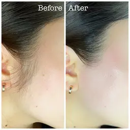 【うぶ毛＆角質ケア】フェイシャル ワックス脱毛✨