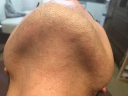 【男性】ひげ脱毛(頬、鼻下、あご、あご下)