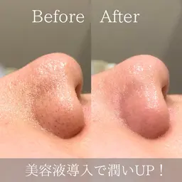 【先着10名限定‼️】毛穴洗浄体験+角栓除去パック🪄ニキビ・くすみ¥10,000▶︎¥0 詳細確認必須