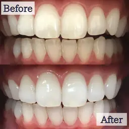 【🌅年末年始キャンペーン🌅】8分照射×2回の大人気定番メニュー💎ホワイトニングデビューはここから🔰