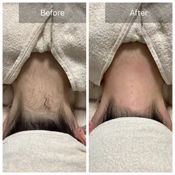 即日うなじ美人✨うなじWAX脱毛