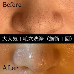 【3/4（水）特別価格】毛穴ごっそり洗浄フェイシャル🥚✨モニター価格