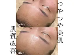 ニキビケア肌改善ハーブピーリング(ダウンタイム無) +LED光フェイシャル