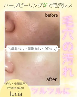 🌟祝・オープン記念🌟【潤いツヤ肌リフトコース✨】碧ハーブピーリング+極冷密封💎