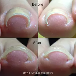 人気1位【巻き爪専門】初めての巻き爪矯正 1ヵ所☆¥10100～¥12000 ⇒¥9000
