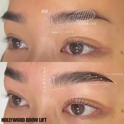 ハリウッドブロウリフト（HBL）