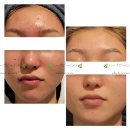 【学生限定】🌿ハーブピーリングモニター🌿毛穴洗浄付き