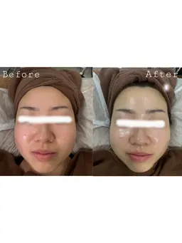 ✨【透明感UP美肌】シミ・くすみ・たるみ改善フェイシャルコース✨