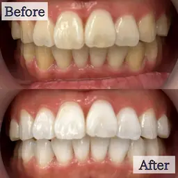 【1日で白さを最大限実感したい方へ🔥5分照射×6回】通常の2倍の照射パワーで効果抜群の最新セルフホワイトニング✨