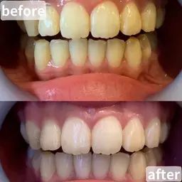 【早さと効果に自信👑5分×4回照射🦷🌈】通常の約２倍の照射パワーで高速ハイパワーセルフホワイトニング‼️