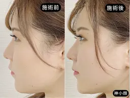 【二重アゴ・エラ集中◎】美容鍼×EMS（くいしばり）70分