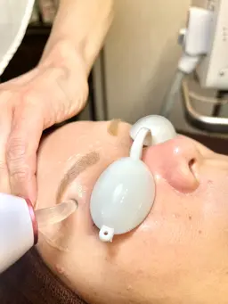 女性/初回限定🌸お顔全体脱毛☆極細ヘッド使用で眉下、眉間なども細かく隅々まで脱毛✨