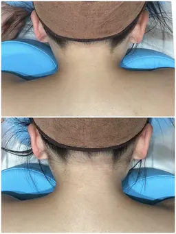 2026年成人式前うなじ脱毛👘🎍脱毛未経験の方大歓迎🥳着物を着るなら襟足の脱毛は必須です✨