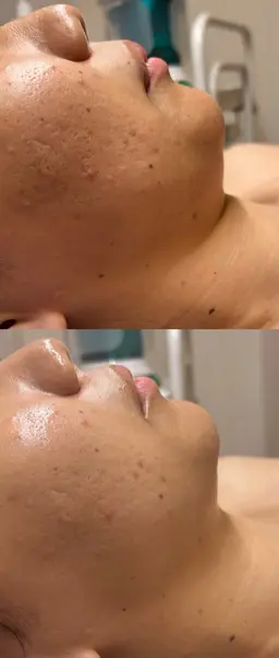 毛穴洗浄＋ハーブピーリング🌿