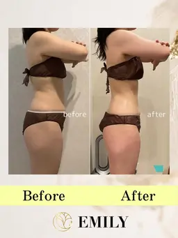 痩身キャビテーション(全身)